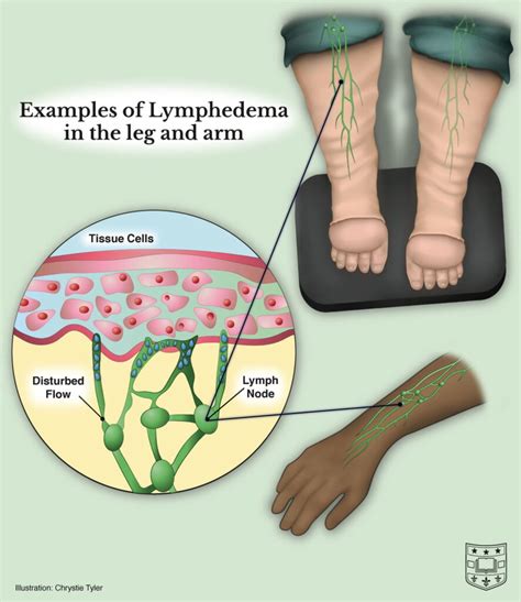 legs leaking fluid|Causes & Treatment – Lymphoedema / Oedema of。